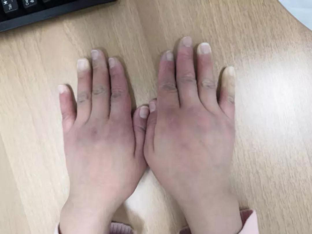 “手指、腳趾發(fā)白、發(fā)紫……”這些“小毛病”千萬別大意