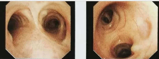 西安國際醫(yī)學中心醫(yī)院成功開展首例鞘管引導的經(jīng)支氣管鏡冷凍肺活檢術(shù)GS-TBLC