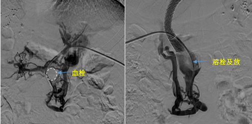 血栓攔路，如何破局——罕見巨大門靜脈血栓TIPS手術(shù)實(shí)錄