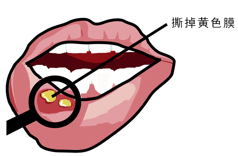 經(jīng)?？谇粷儯娴闹皇侨本S生素嗎？