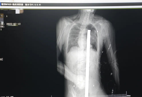 1.2米長的鋼筋貫穿男子胸腹！情況極度危險......