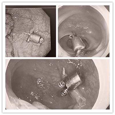 消化病醫(yī)院內(nèi)外科聯(lián)合開展3例“磁環(huán)預(yù)標(biāo)記輔助腹腔鏡結(jié)、直腸癌根治術(shù)”