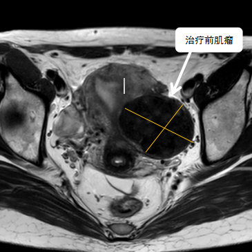 保子宮、保留生育功能—磁波刀治療子宮肌瘤