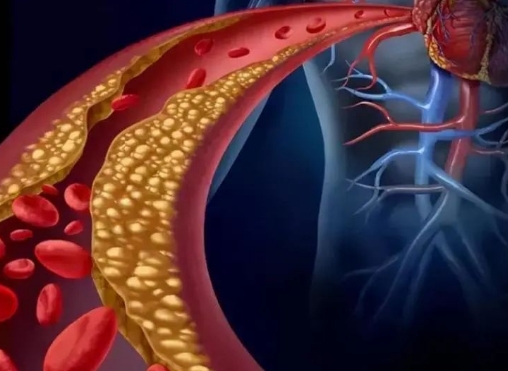 警惕！冠脈支架術(shù)后這些誤區(qū)千萬(wàn)別踩，趕緊收藏！