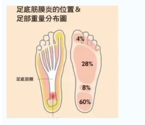 每年新生數(shù)百萬足底筋膜炎患者！國(guó)際醫(yī)學(xué)專家提醒：跑步要選擇合適的鞋