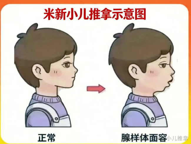 兒童腺樣體肥大只能手術(shù)？不，一位媽媽的親身經(jīng)歷給出另一種答案